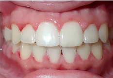 After treatment
